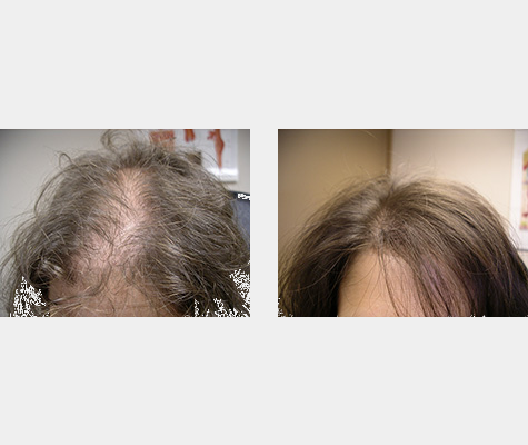 Laser Light Therapy