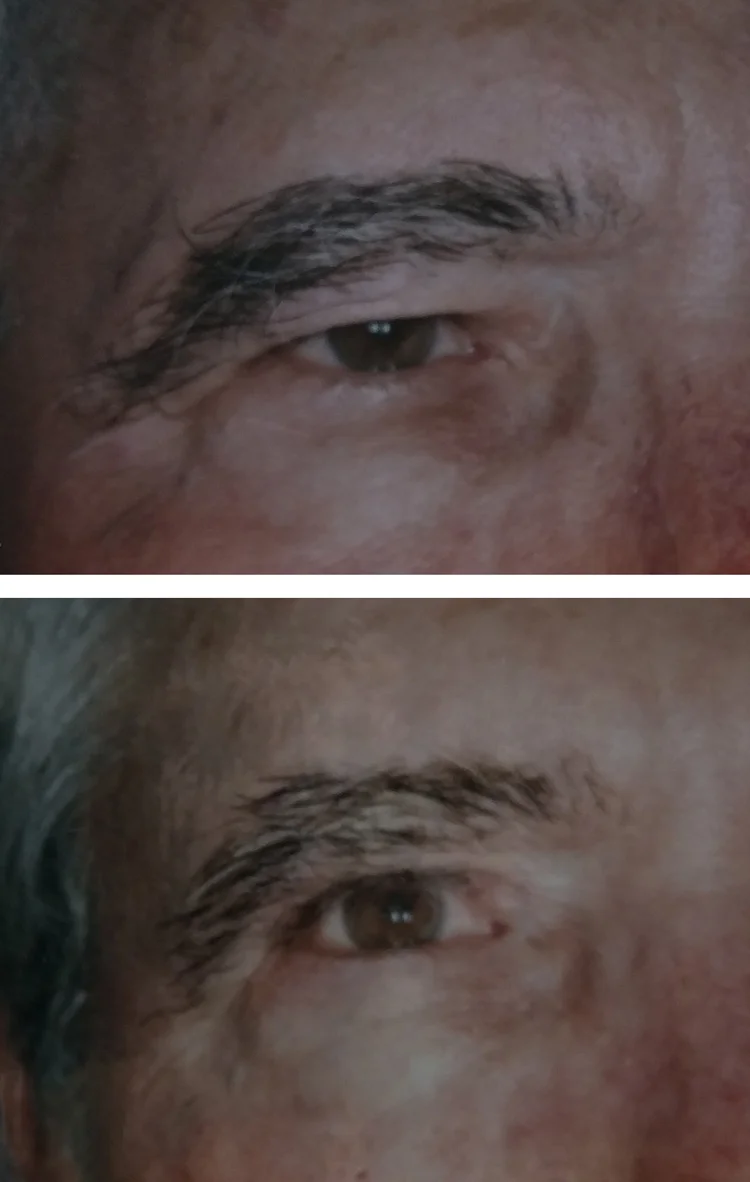 Blepharoplasty/eyelid tuck before & after