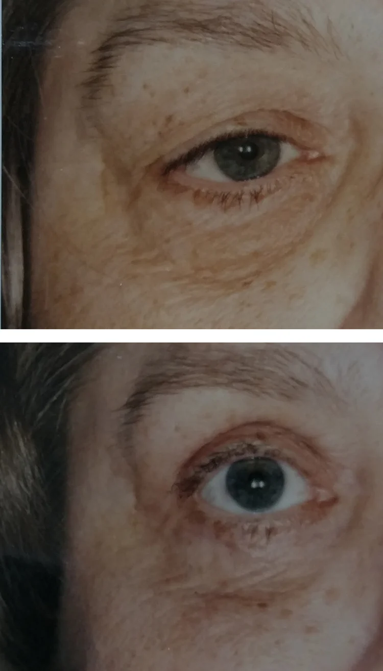 Blepharoplasty/eyelid tuck before & after