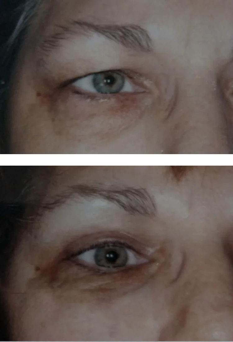 Blepharoplasty/eyelid tuck before & after