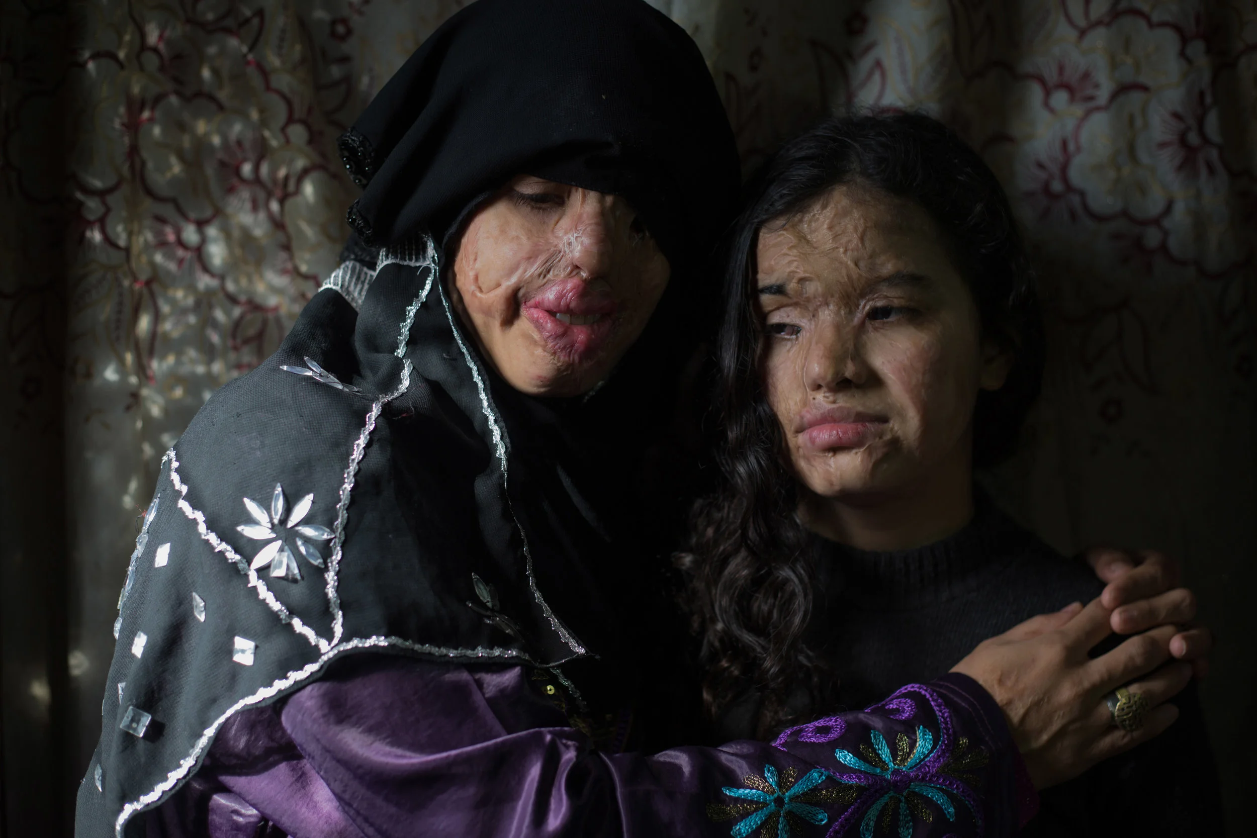 HADEER MAHMOUD www.hadeermahmoud.com | @hadeermahmoud1 Eman, a woman who faced malformation by her husband. Eman and her daughter who is 13 years old were attacked with acid after she fill for divorce.