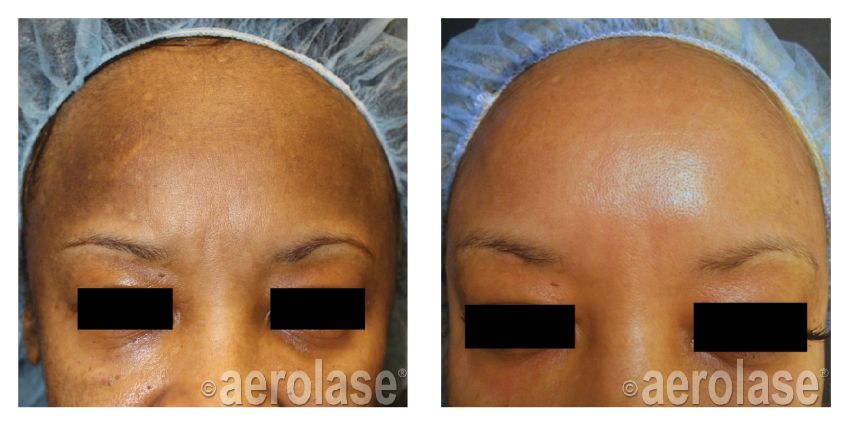NeoSkin Melasma - After 1 Treatment combined with Glycolic Peel - Cheryl Burgess MD.jpg