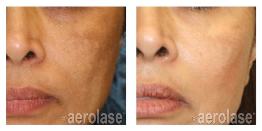 NeoSkin Melasma - After 1 Treatment combined with Hydroquinone - Cheryl Burgess MD.jpg