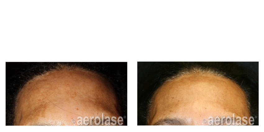 NeoSkin Melasma - After 1 Treatment combined with TCA Peel - Cheryl Burgess MD.jpg