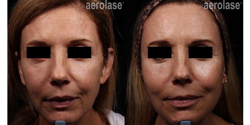 NeoSkin Rejuvenation - After 2 Treatments combined with threads and filler - One Aesthetics.jpg
