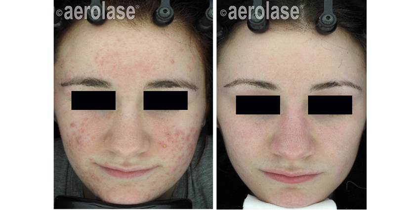 NeoClear Acne - 3 Months After 5 Treatments - David Goldberg MD.jpg