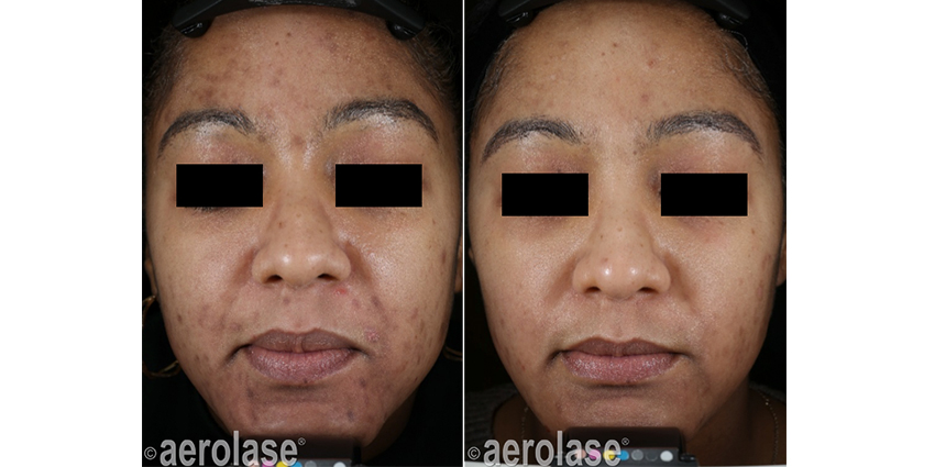 NeoClear Acne - 5 Months After 3 Treatments - David Goldberg MD.jpg