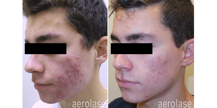 NeoClear Acne - After 4 Treatments - Kevin Pinski MD.jpg