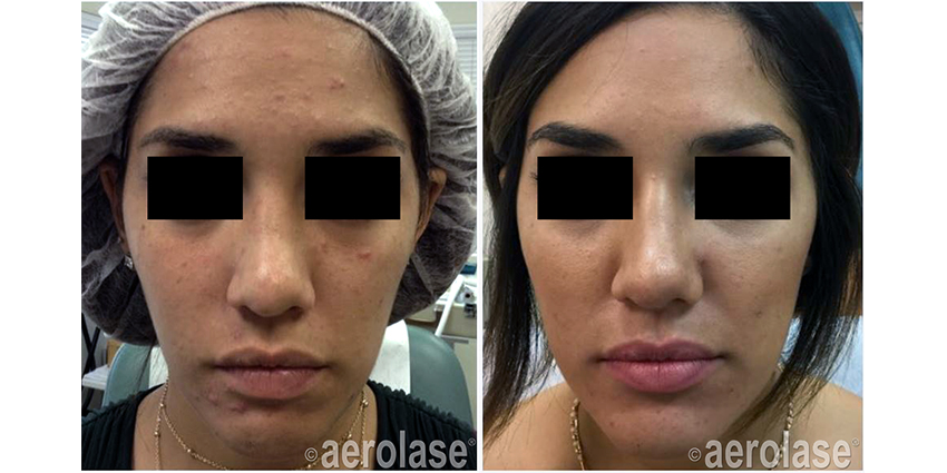 NeoClear Acne - After 4 Treatments - Mark Nestor MD.jpg