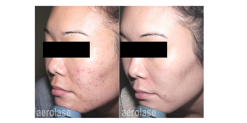 NeoClear Acne - After 6 Treatments - Spade Skin Care.jpg