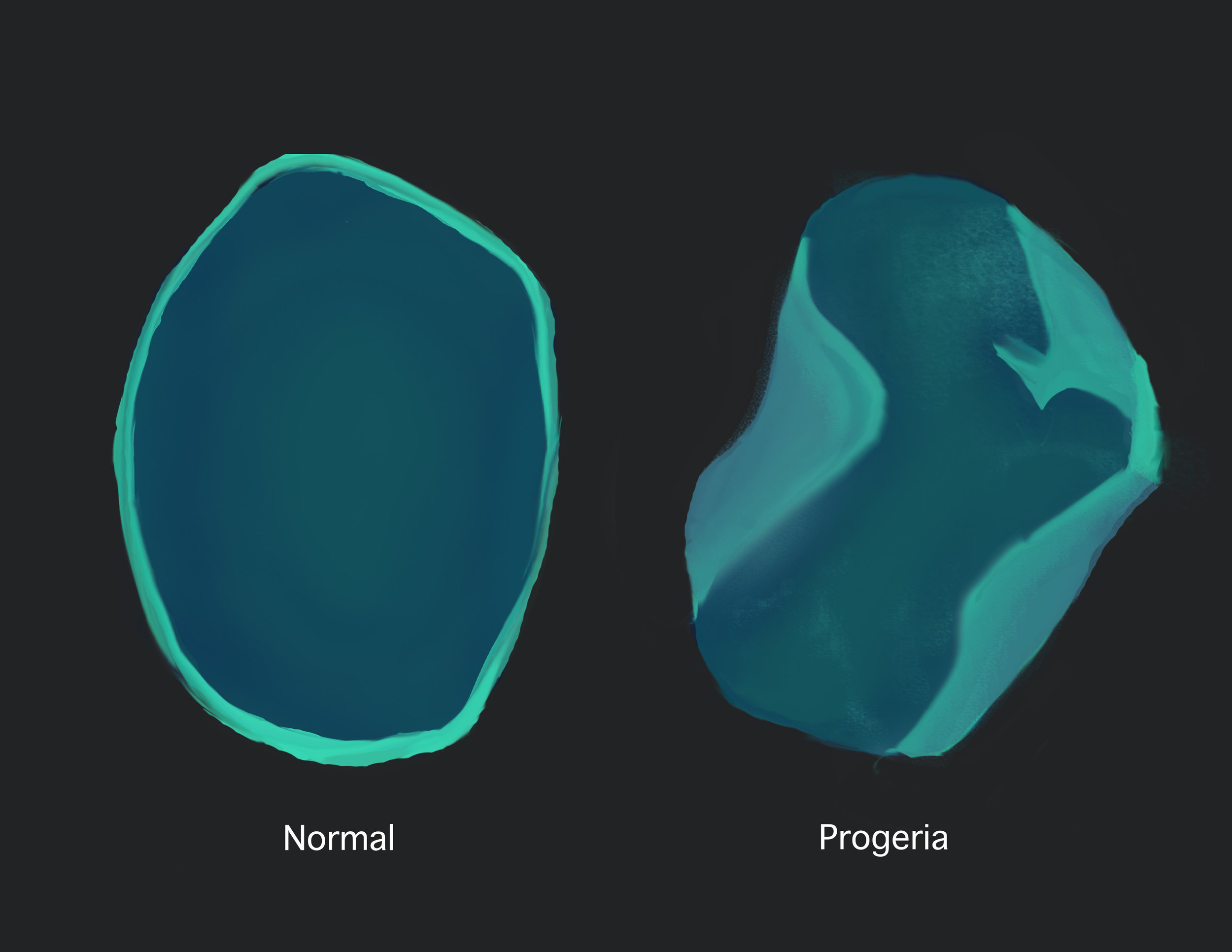 Appearance of a normal cell nucleus (left) and one from a patient with progeria (right).