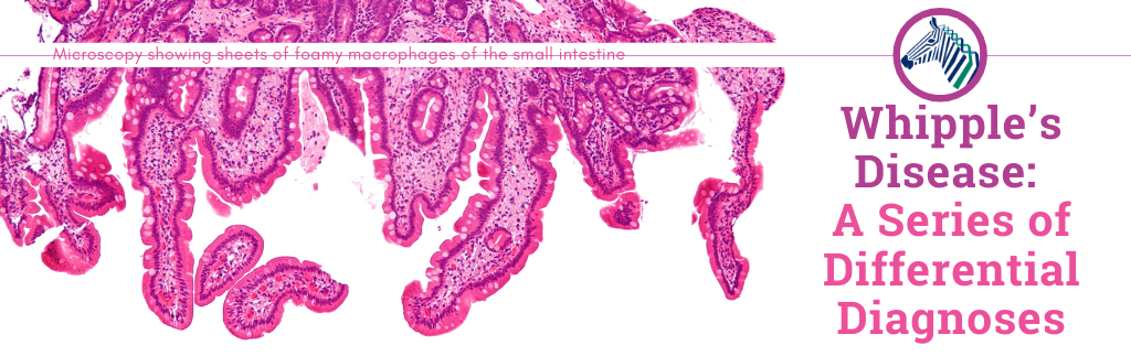 Whipple’s Disease: A Series of Differential Diagnoses