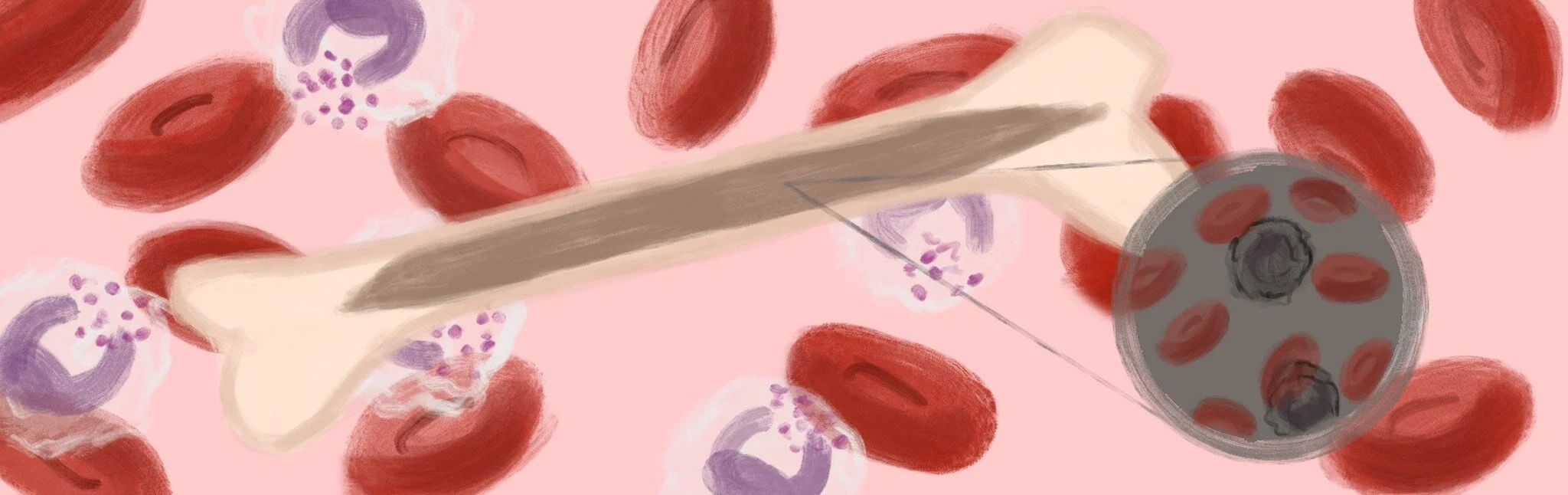 Recent Findings and Current Research for Shwachman-Diamond Syndrome