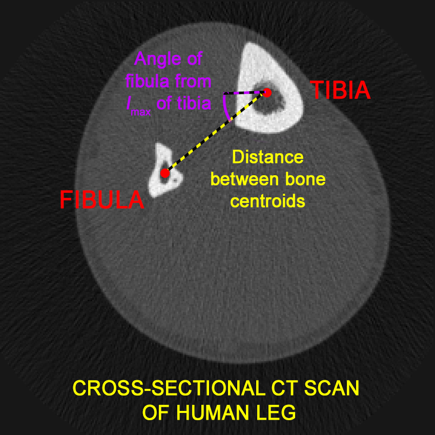 CT scan image taken from data collected by Dr. Colin Shaw and used in the forthcoming publication, showing the two measures of relative position between the tibia and fibula.