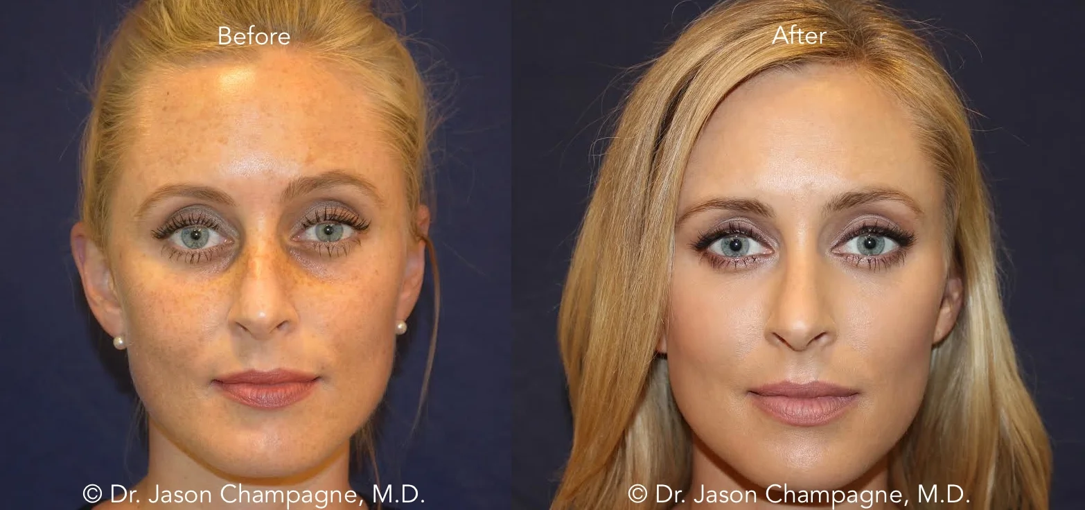 Facial Filler Treatment Beverly Hills Dr. Jason Champagne Beverly