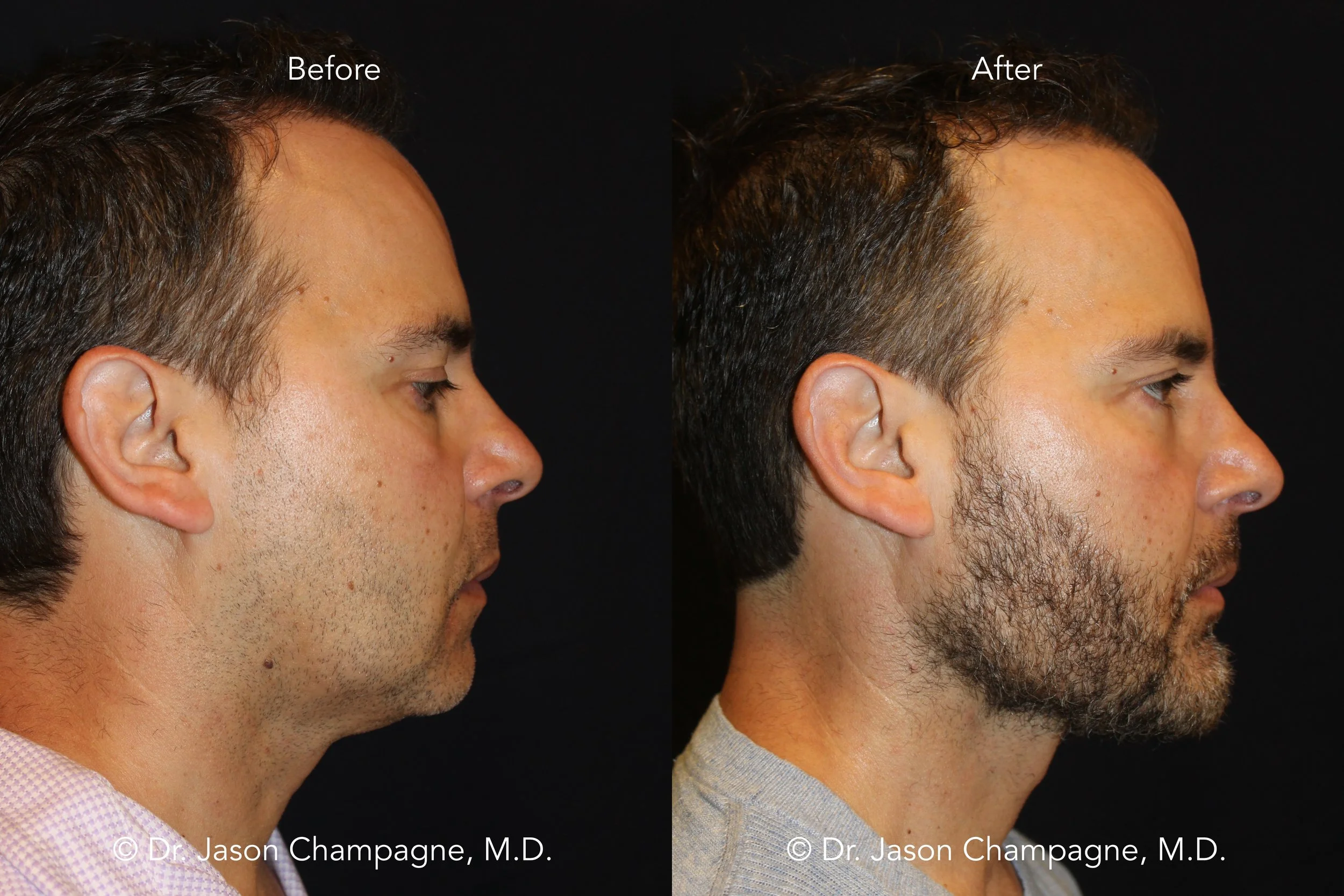 cheekbone implants men before and after