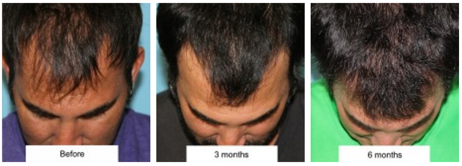 Hairline Lowering vs. Hair Transplantation — Plastic Surgeon Beverly Hills,  CA | Dr. Jason Champagne