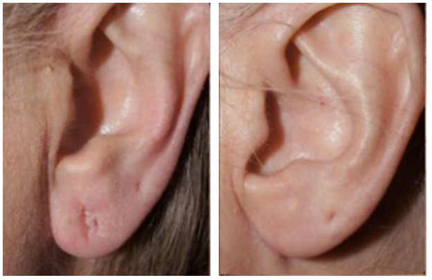 Burt and Will Plastic Surgery and Dermatology - ⭐ Patients contact us for  earlobe reconstruction for a variety of reasons.👂Whether it is for  repairing split ears from wearing heavy earrings, stretched earlobes