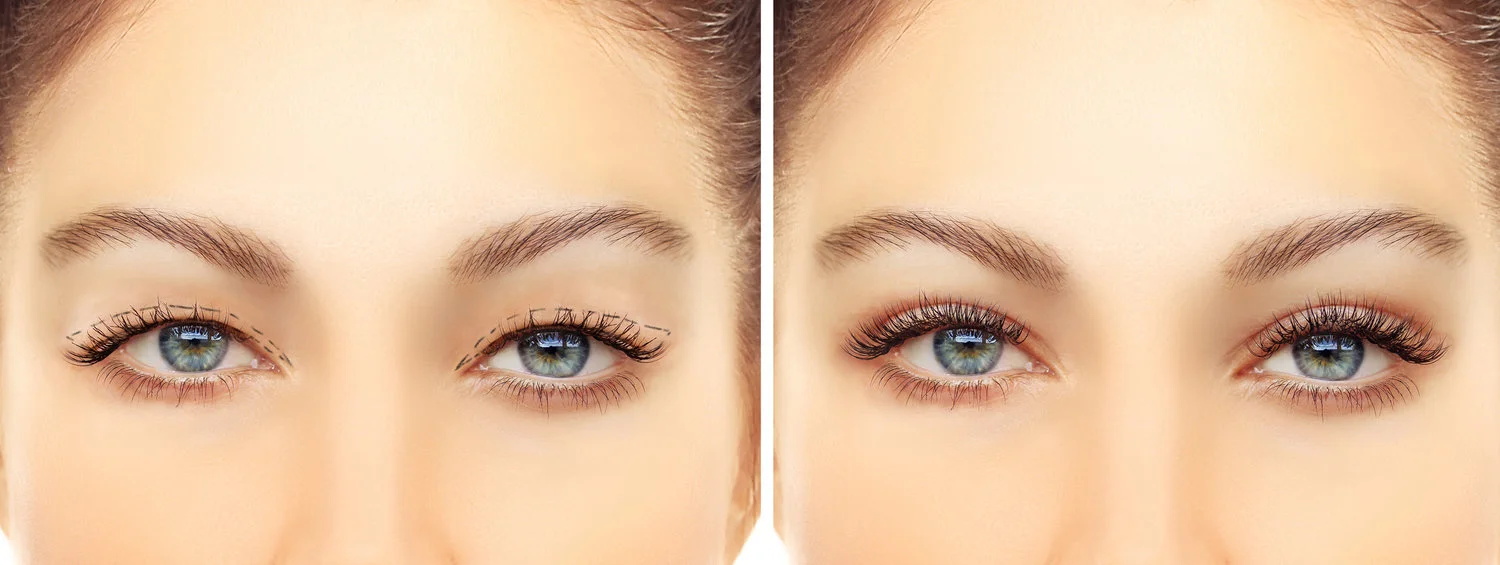 Blepharoplasty+Eyelid+Facial+Plastic+Surgery+Beverly+hills.jpg
