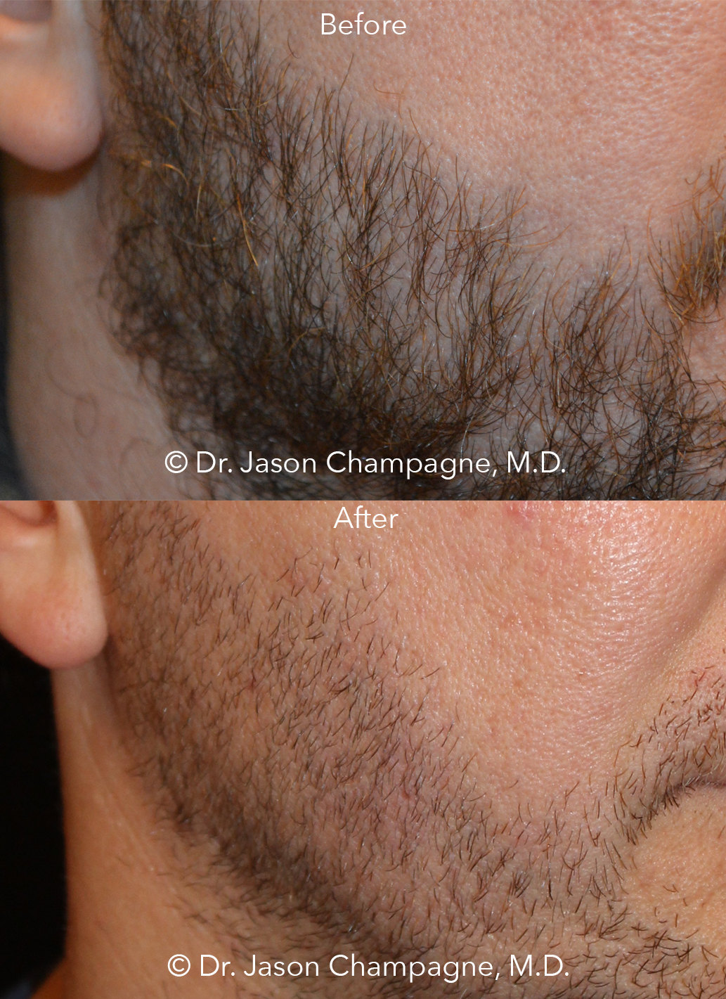 Get that beard into shape this season — Plastic Surgeon Beverly Hills, CA |  Dr. Jason Champagne