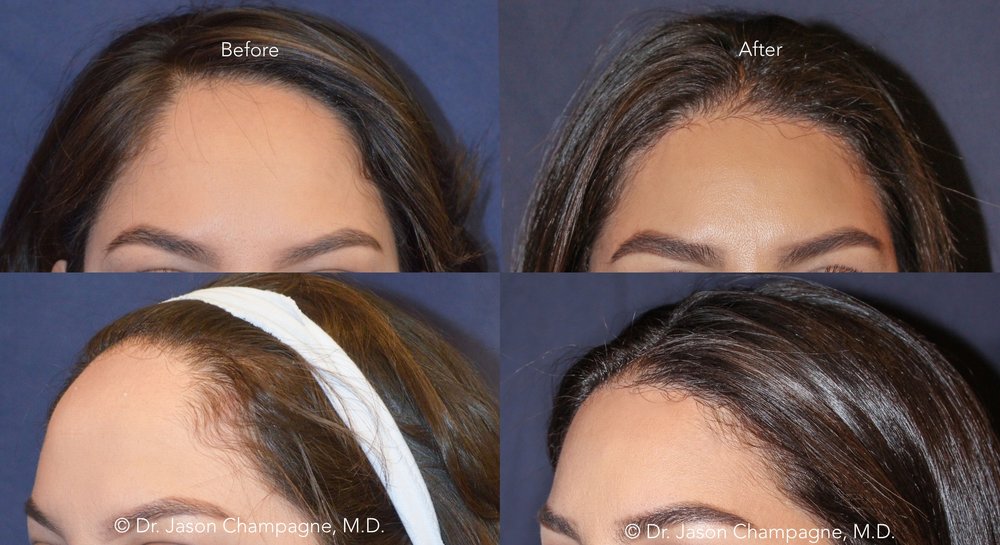 Preparing for a Hairline Lowering or Forehead Reduction Surgery — Plastic  Surgeon Beverly Hills, CA | Dr. Jason Champagne
