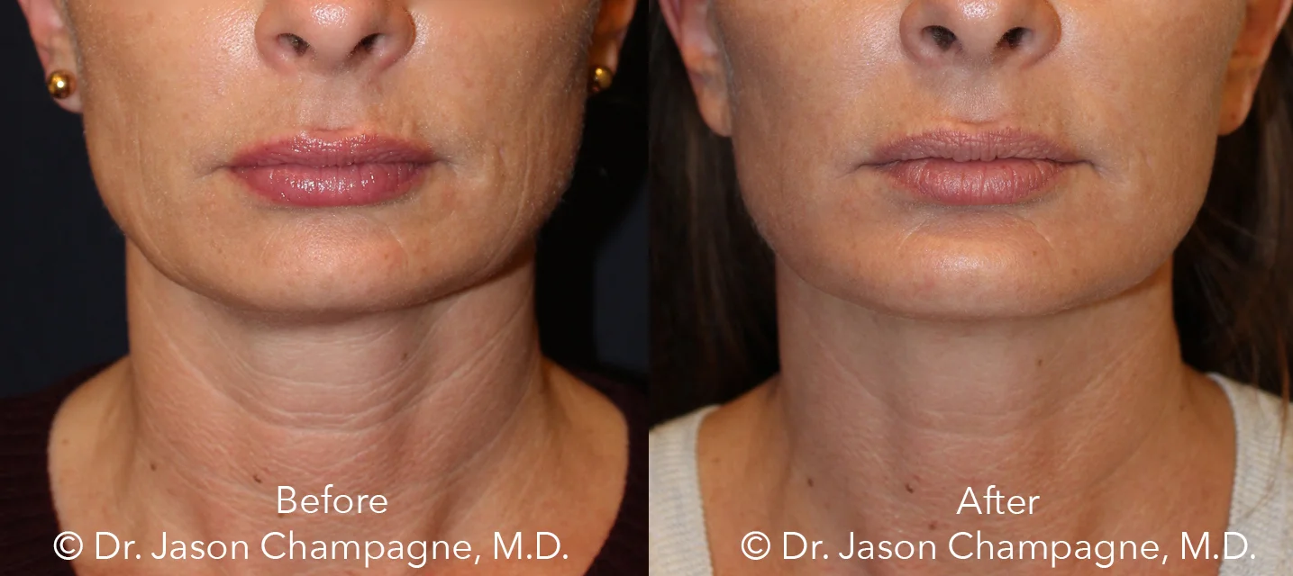 Take Years Off Your Appearance with a Mini Facelift — Plastic Surgeon