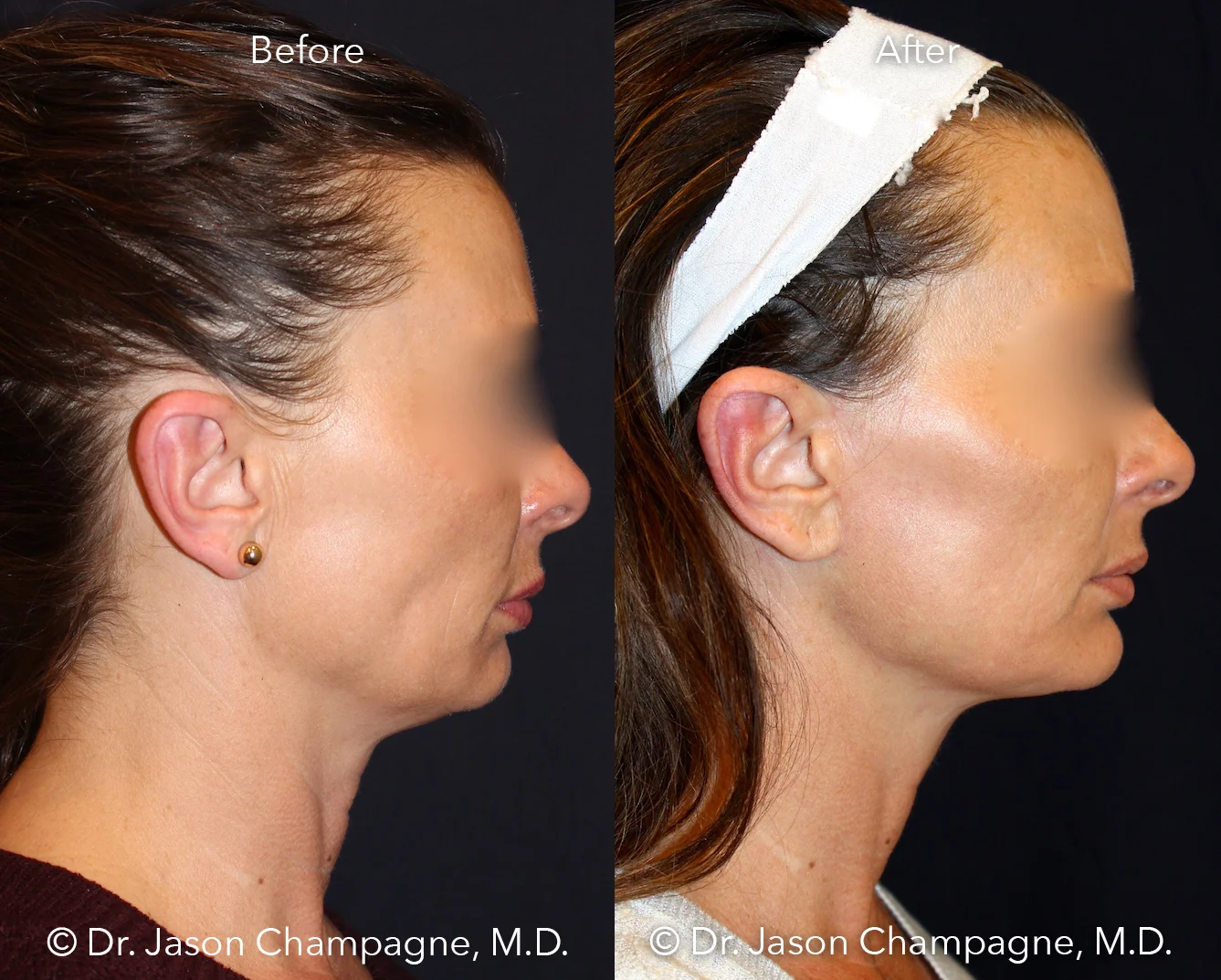 Dr-Jason-Champagne-mini-facelift-necklift-chin-implant-CO2 laser-skin-resurfacing-Before-and-After-Profile.jpg