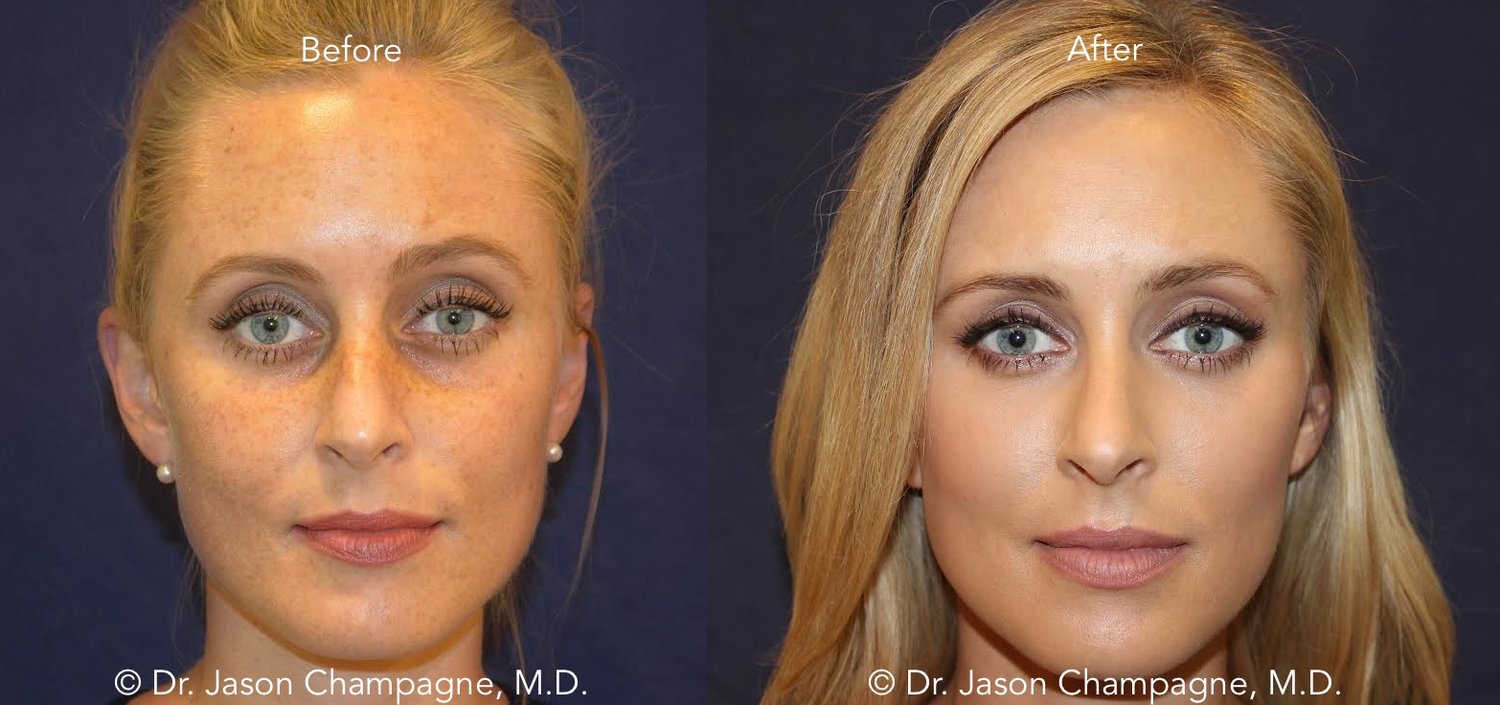 Orange County Facial Rejuvenation Surgery