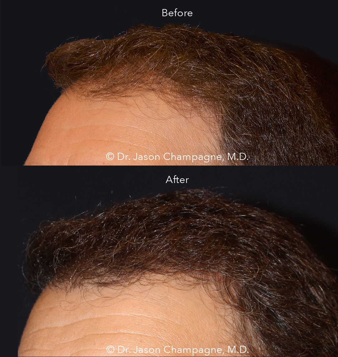 What You Should Know Before Getting A Hair Transplantation — Plastic  Surgeon Beverly Hills, CA | Dr. Jason Champagne