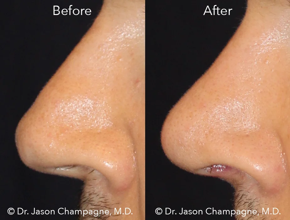 Dr-Jason-Champagne-Plastic-Surgery-tip-rhinoplasty-male-rhinoplasty-finesse-tip-rhinoplasty-before-and-after.jpg