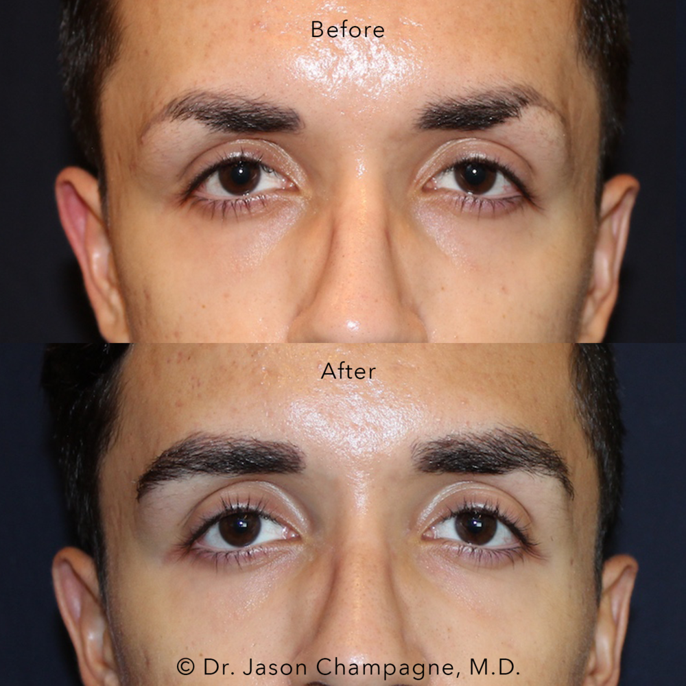 Male Eyebrow Hair Transplant — Plastic Surgeon Beverly Hills, CA | Dr.  Jason Champagne