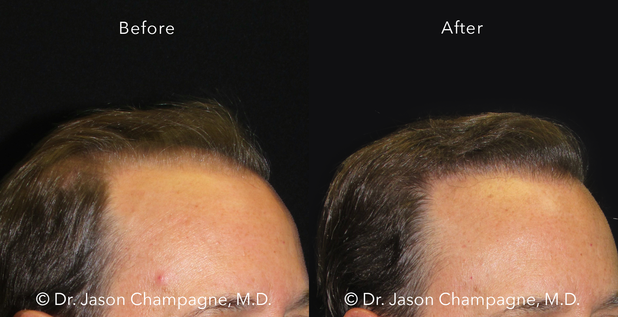 Hair Transplantation Gallery | Beverly Hills Plastic Surgeon - Dr. Jason  Champagne