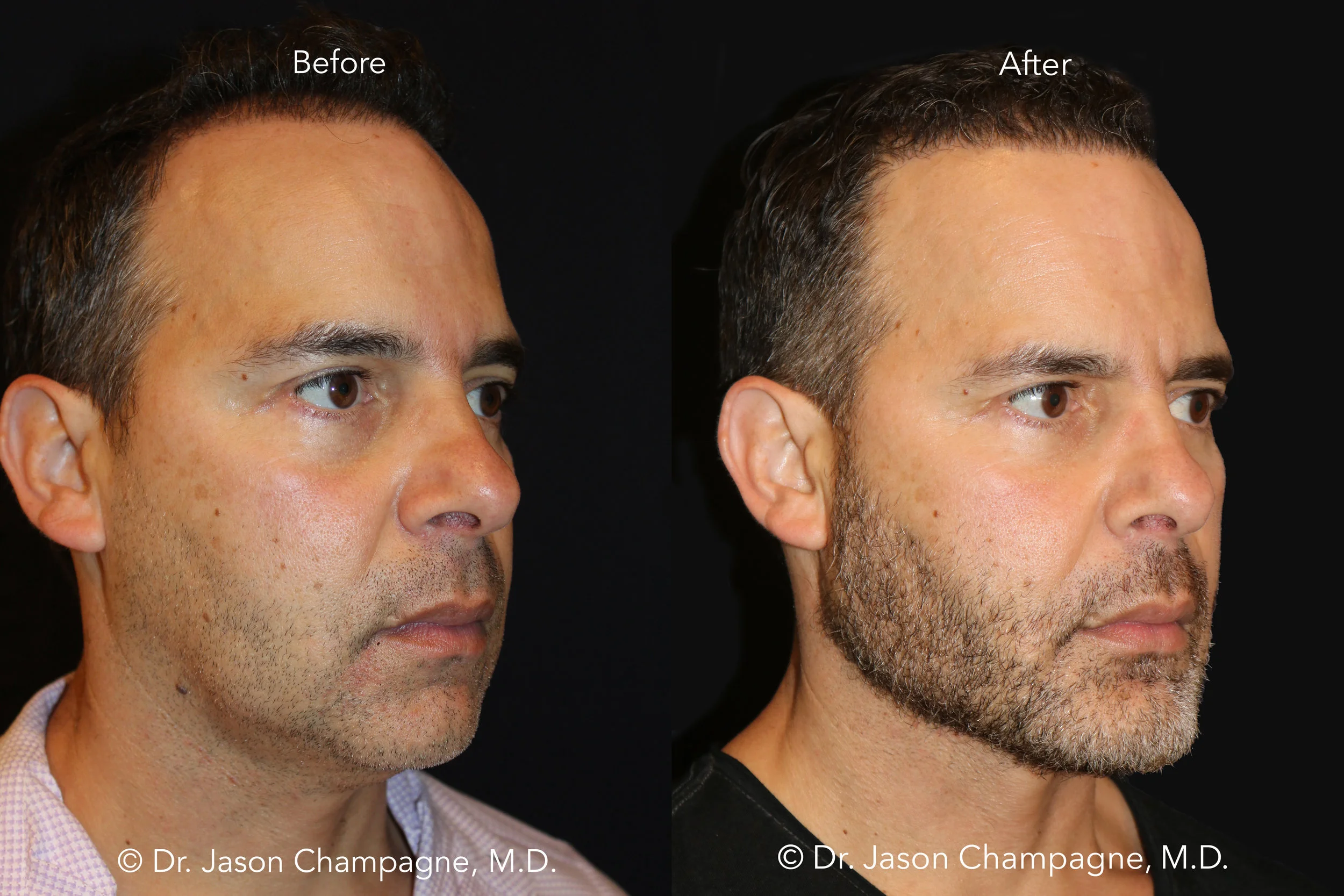 Dr-Jason-Champagne-Custom-Chin-and-Jaw-Hair-Transplantation-Before-and-After-3_4.jpg