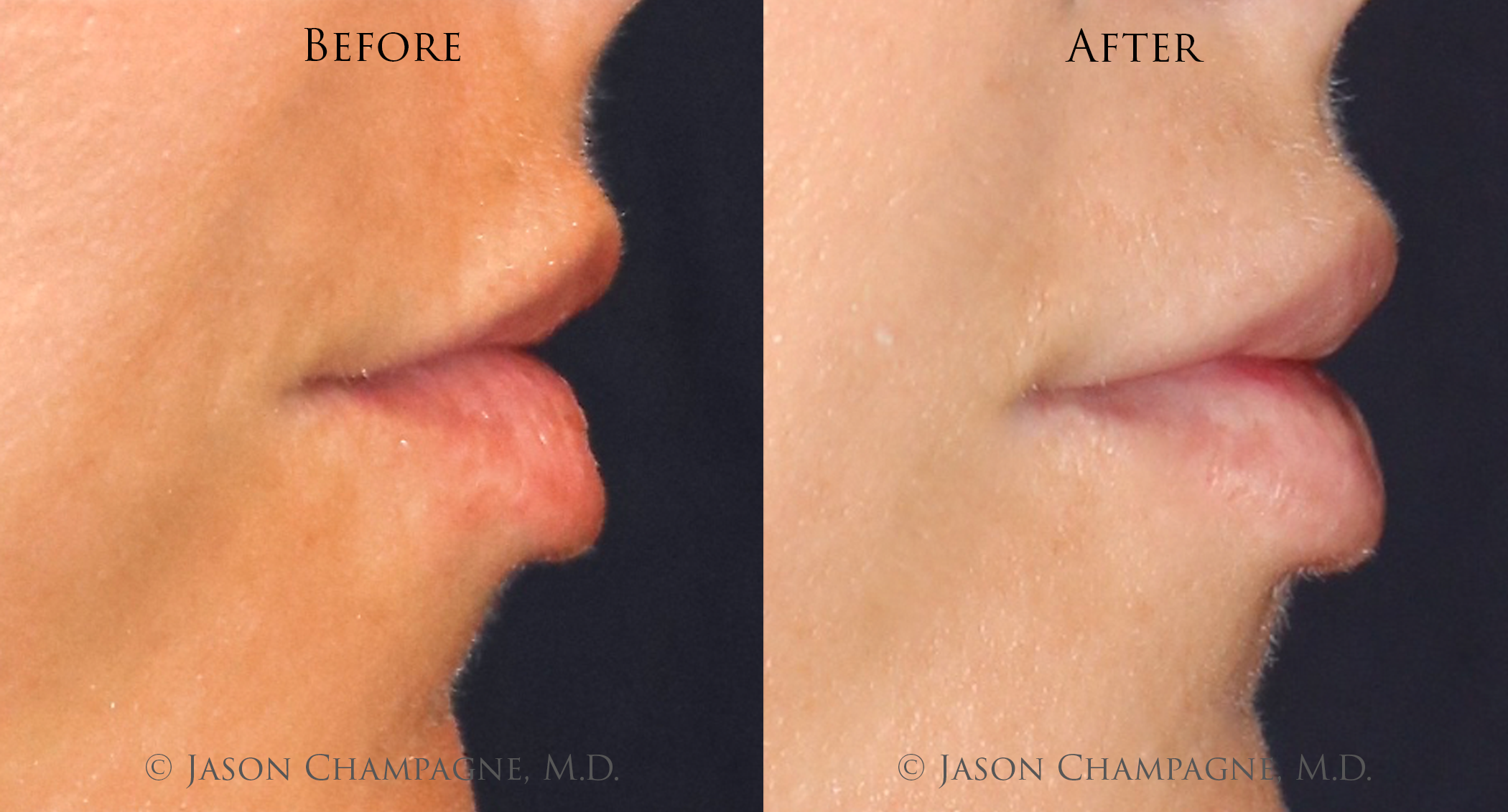 Jason-Champagne-Lip-Augmentation-Before-and-After