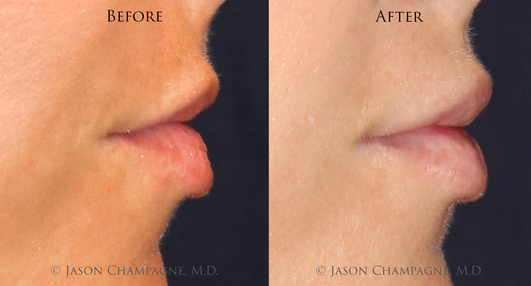 Jason-Champagne-Lip-Augmentation-Before-and-After.png