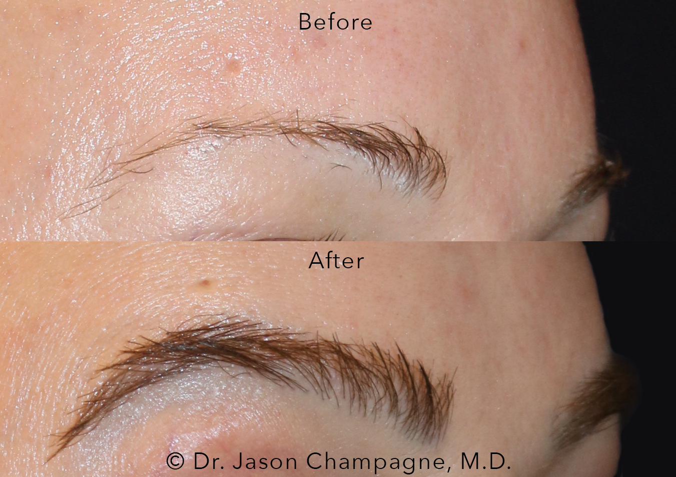 Eyebrow Hair Transplantation: Get Superior and More Natural-Looking Results  than Microblading — Plastic Surgeon Beverly Hills, CA | Dr. Jason Champagne