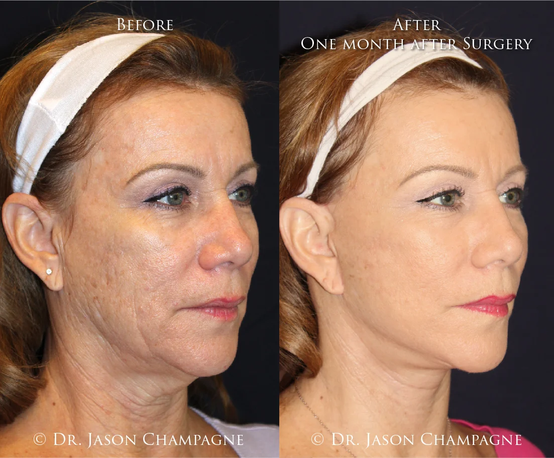 Dr-Jason-Champagne-Facelift-oblique-and-Necklift-Before-and-One-Month-After-Surgery-01.jpg