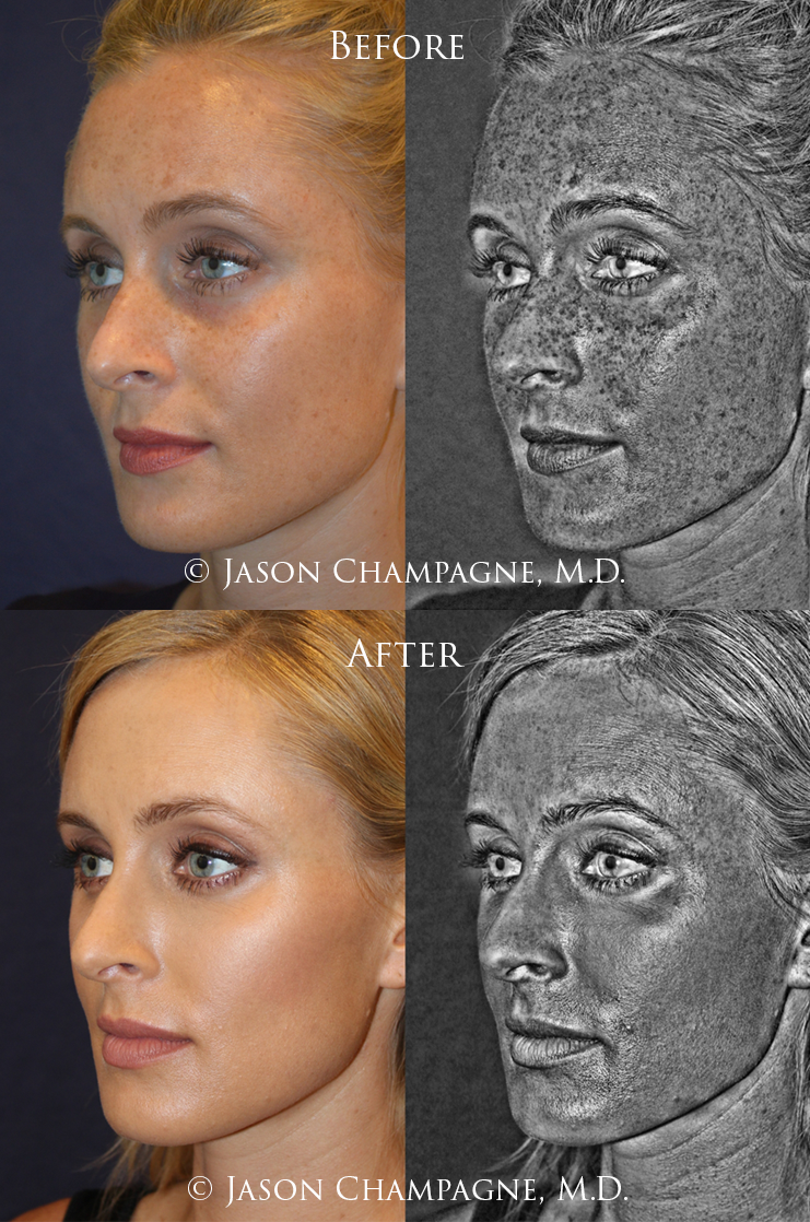 Jason-Champagne-IPL-Before-and-After.png