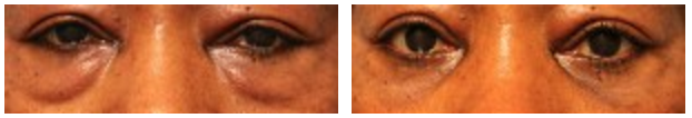 Reduce Tired and Drooping Eyes: Blepharoplasty Procedure 1 Case+3452+Lower+Blepharoplasty