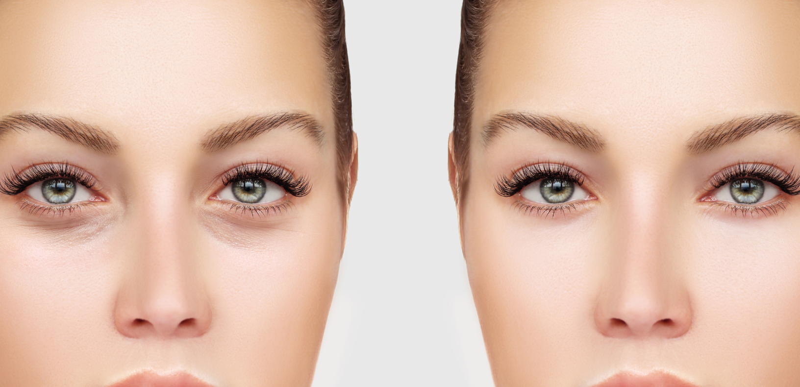 Dr-Jason-Champagne-Blepharoplasty-Procedure.png