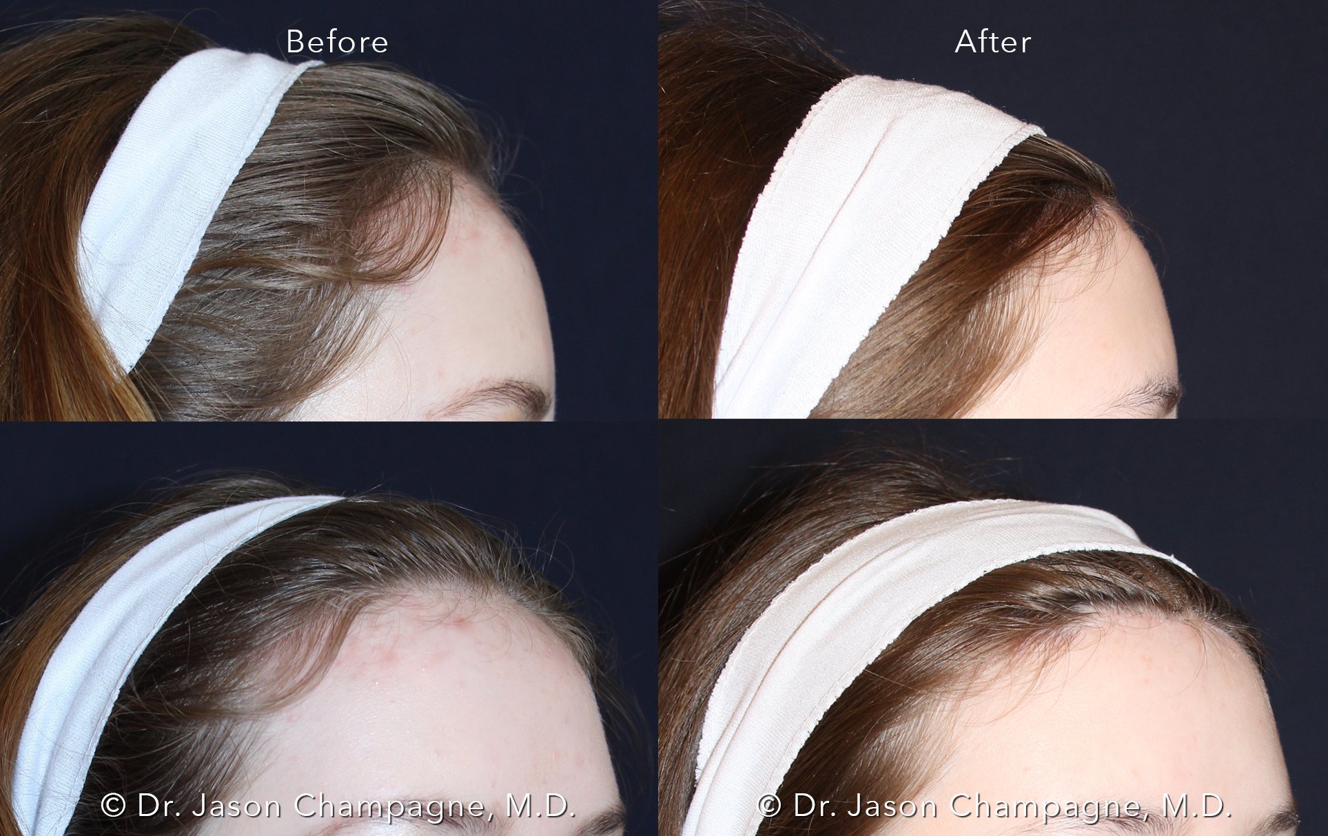 Benefits of a Balanced Face 1 Dr Jason Champagne Hairline Lowering Before and After