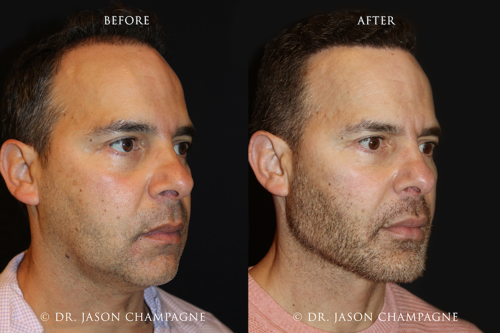 Hair Transplantation Gallery Beverly Hills Plastic Surgeon Dr. Jason Champagne Hair Transplantation Gallery Beverly Hills Plastic Surgeon Dr. Jason Champagne