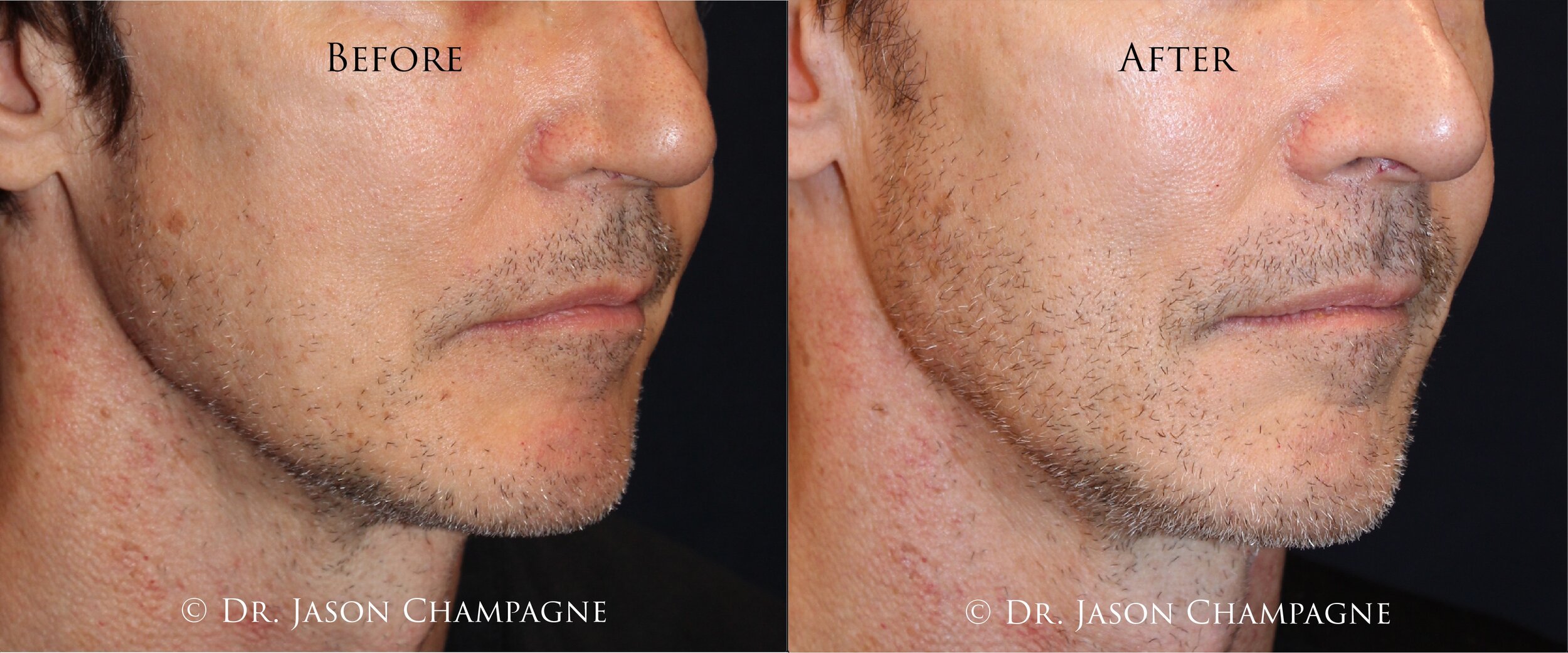 Patchy Beard? Get A Thicker, Fuller Beard With A Hair Transplantation —  Plastic Surgeon Beverly Hills, CA | Dr. Jason Champagne