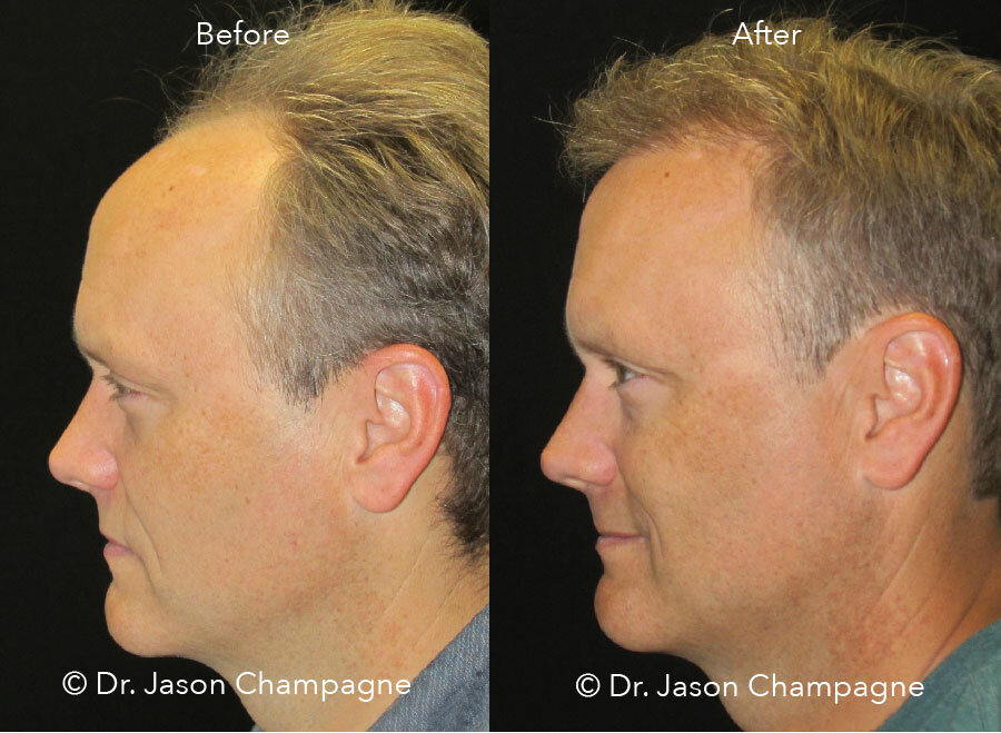 Combat Hair Loss With Your Own Hair — Plastic Surgeon Beverly Hills, CA |  Dr. Jason Champagne
