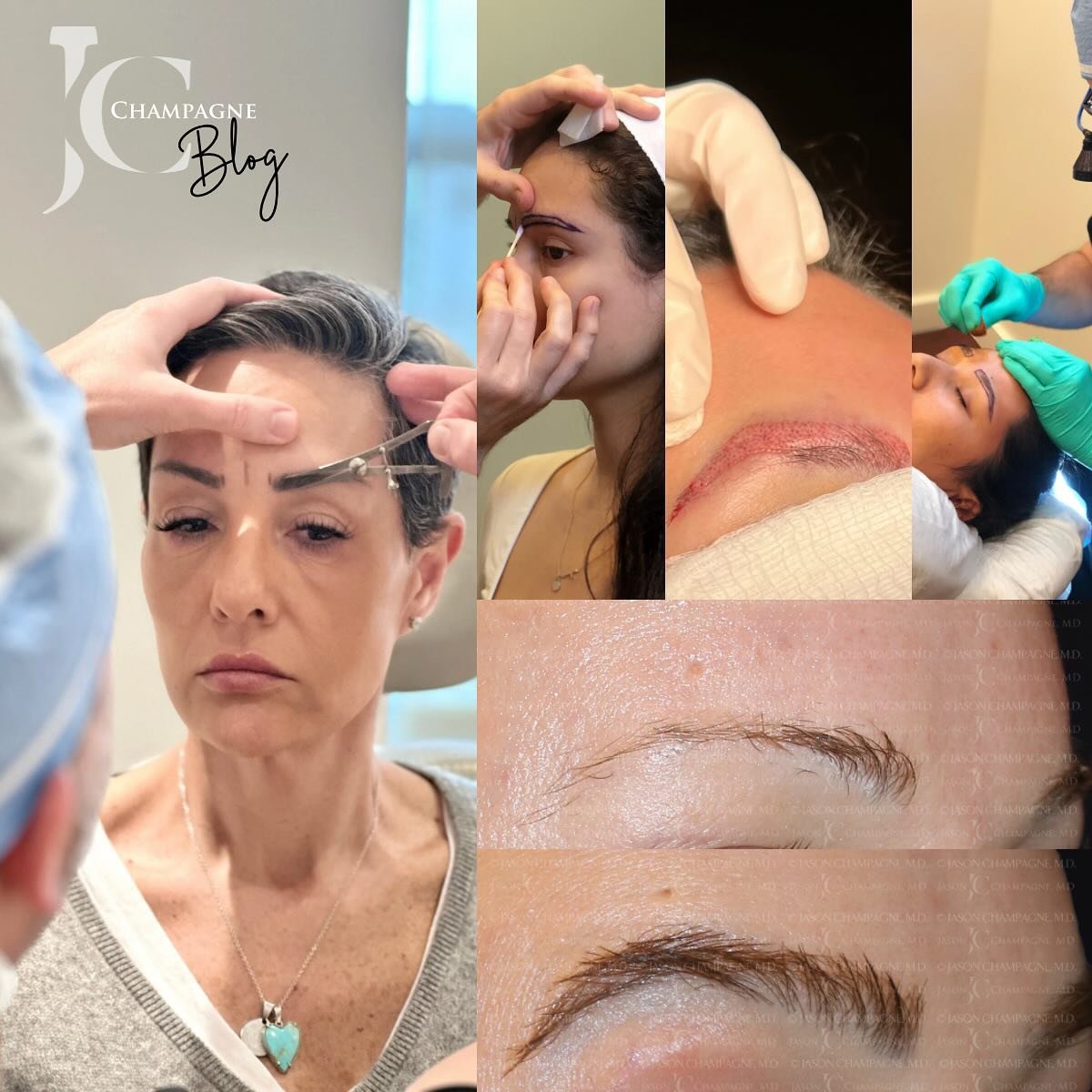 Over the past several months, I&rsquo;ve received a spectrum of inquiries driven by your curiosity. In this blog post, I address your most pressing questions about my signature #ChampagneBrows procedure. Link in bio.
#DrChampagneBlog 
.
.
#eyebrowtra