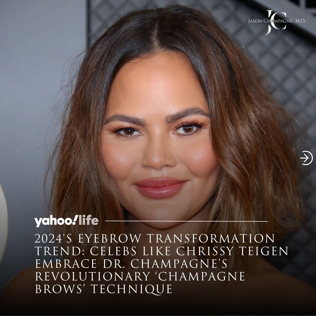Deeply grateful for the fantastic feature on my #ChampagneBrows signature procedure. Thank you @yahoolifestyle! Swipe to read or follow the link in bio. 
#DrChampagneInTheNews 

#chrissyteigen #yahoolife #yahoolifestyle