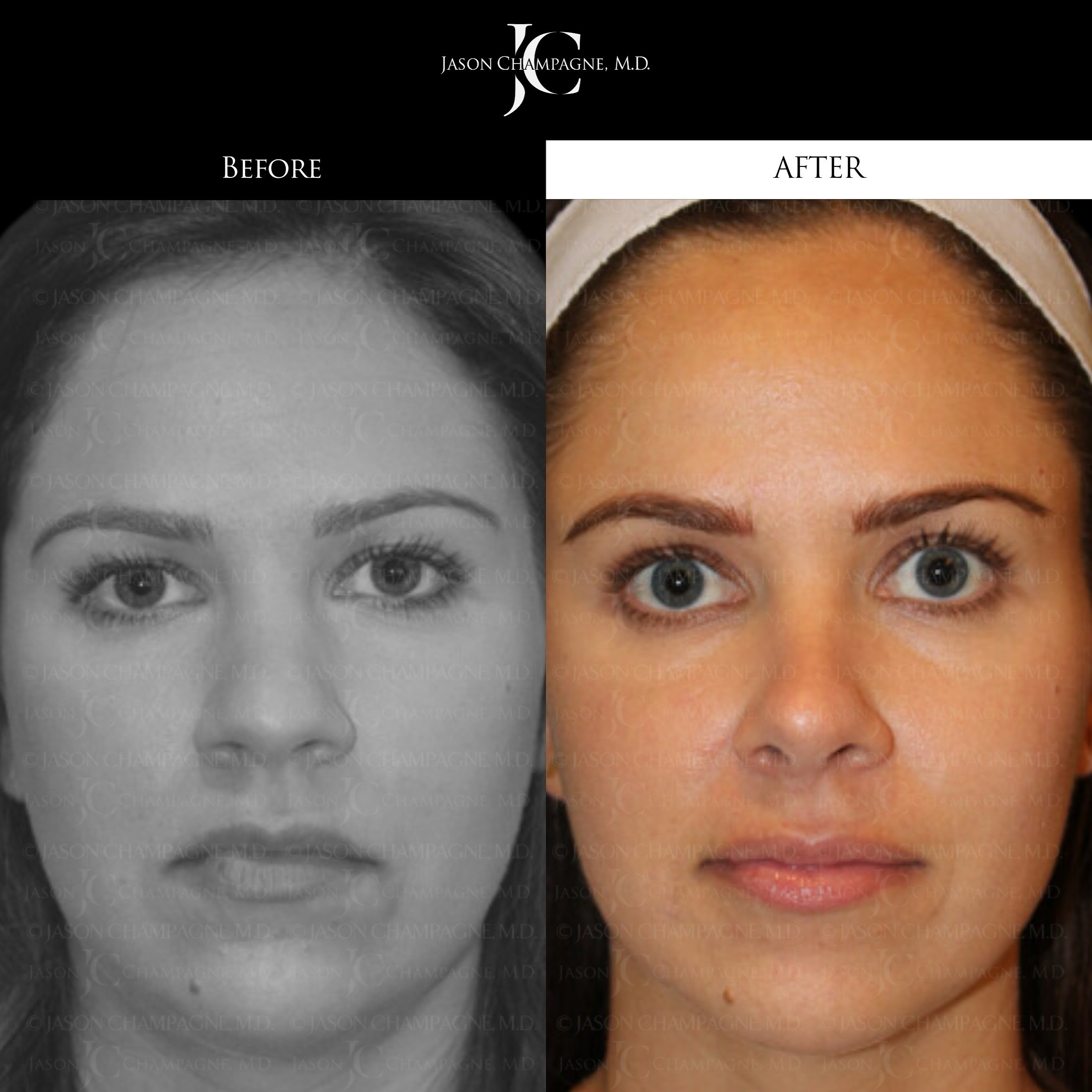 Here&rsquo;s a different patient of mine, who was unhappy with the width and the tip of her nose. Notice the refined shape and improved proportions. #DrChampagneBeforeAndAfters 
.
.
#rhinoplastybeforeandafter #beforeandafterrhinoplasty #beforeandafte
