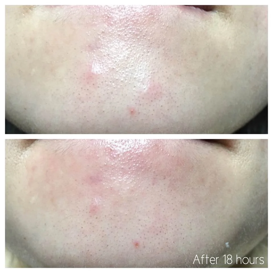 blemish and age defence skinceuticals