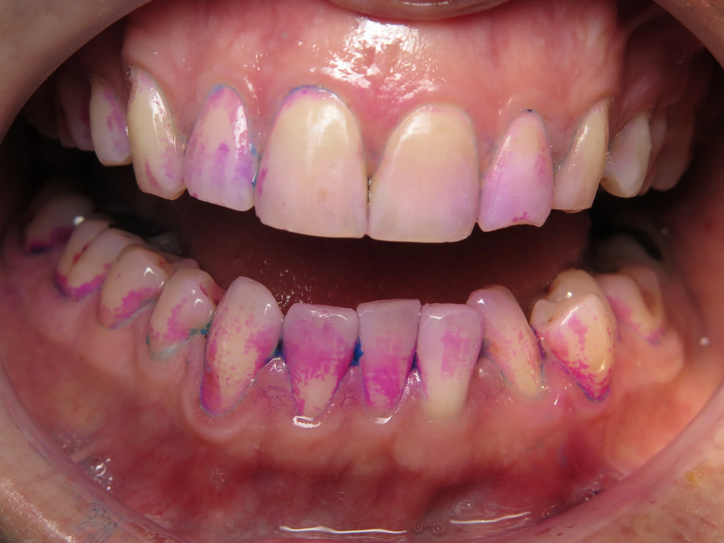 West Auckland Dentist Massey Smiles — If plaque was pink.....