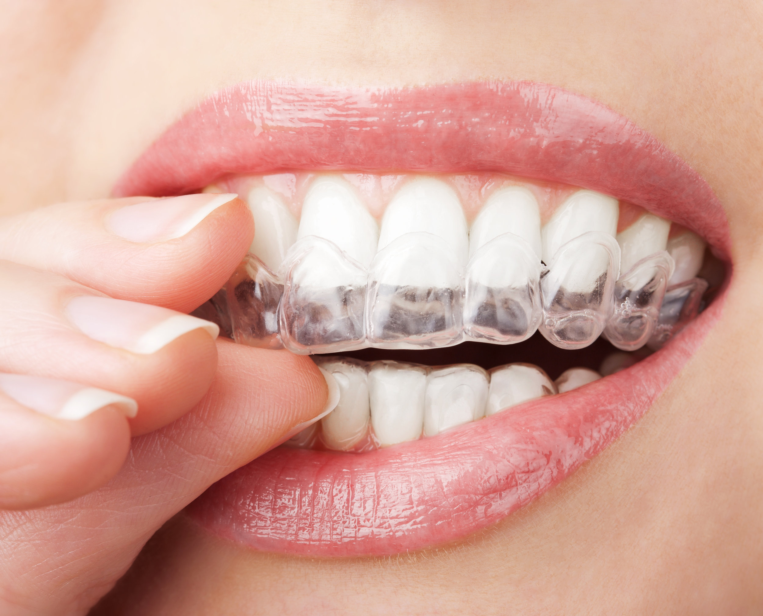 Custom made whitening trays fit your teeth exactly to hold the bleach where you need it.